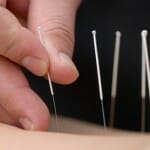 acupunctuur en afvallen