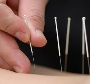 acupunctuur en afvallen